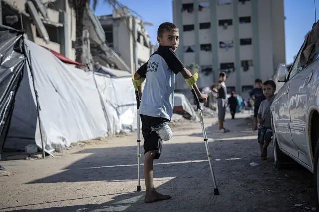 صورة الصحة: 25% من حالات البتر في غزة أطفال يُواجهون إعاقات دائمة