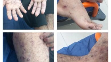 صورة تفشٍّ خطير للجرب بين الأسرى الفلسطينيين في سجون الاحتلال