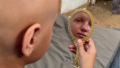 صورة “أحلم أن يعود شعري”.. أمنية طفلة أنهكتها حرب الإبادة بغزة