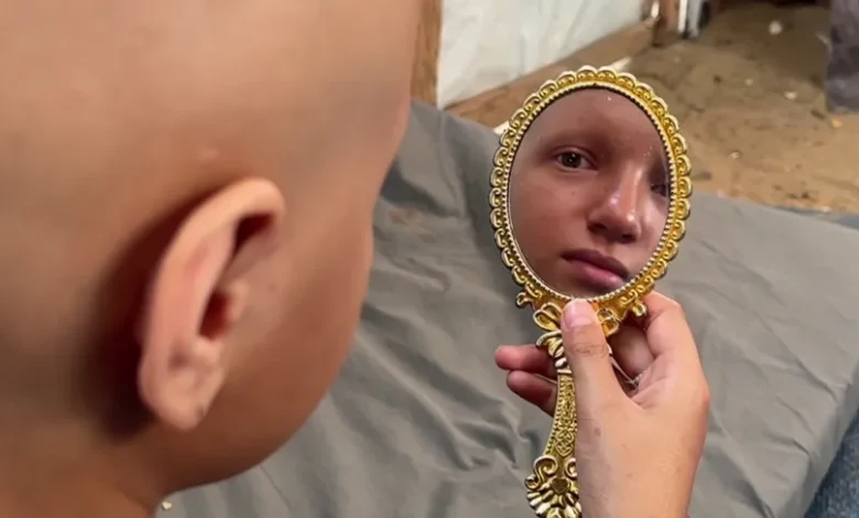 "أحلم أن يعود شعري".. أمنية طفلة أنهكتها حرب الإبادة بغزة